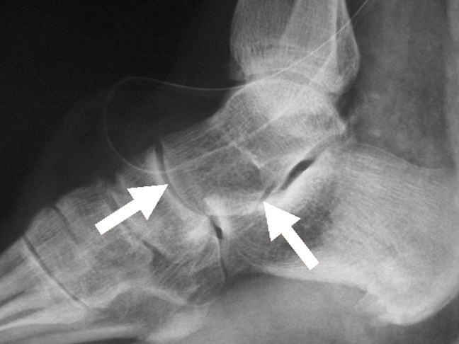 Figure 3: After surgical intervention the dislocation was reduced leaving the talar-calcaneus joint in its normal position (arrow).